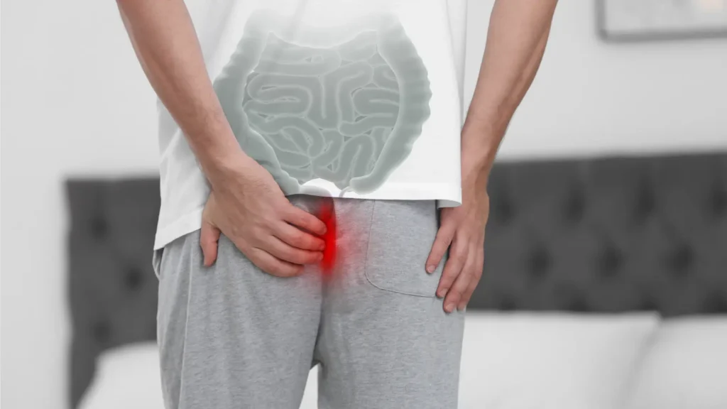 pilonidal sinus Treatment