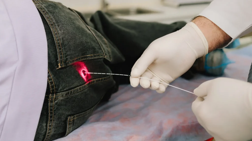 Laser piles therapy in moshi