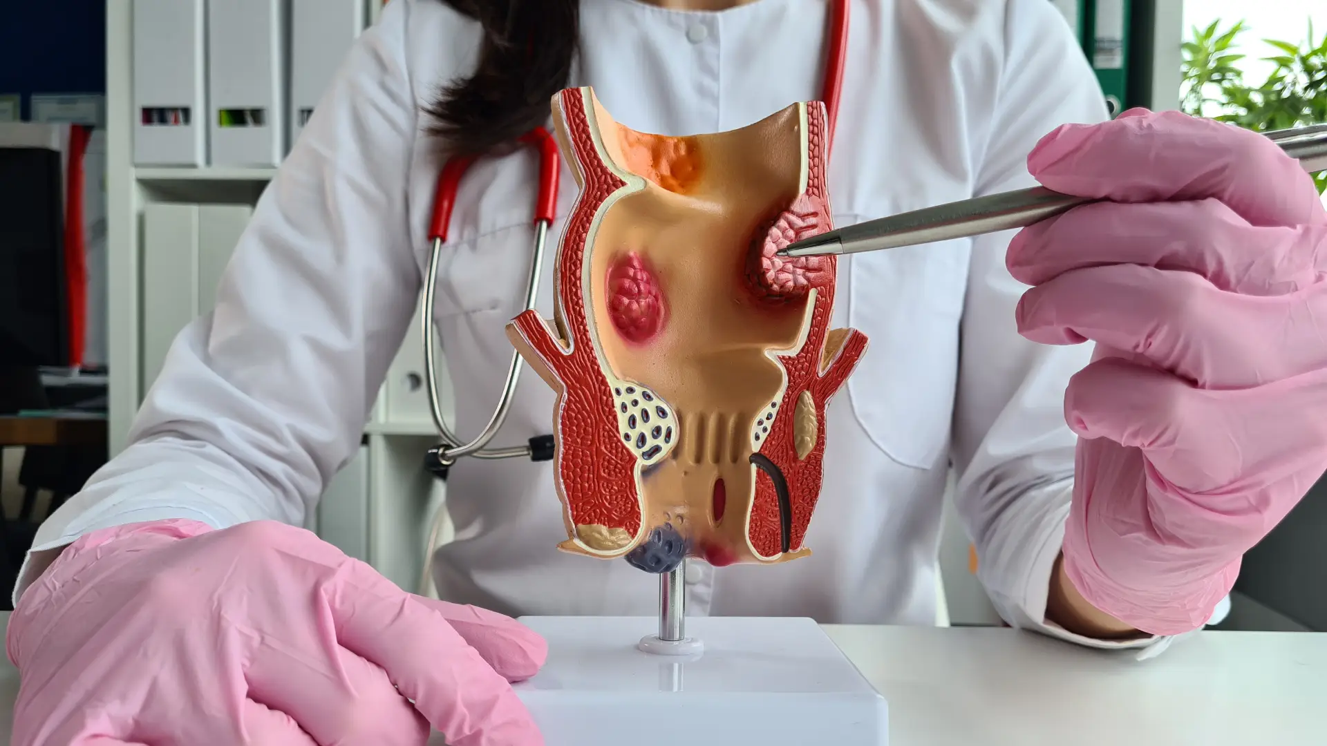 Annal Fissure Treatment in Moshi